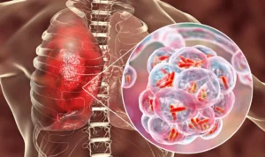 Pneumonia
