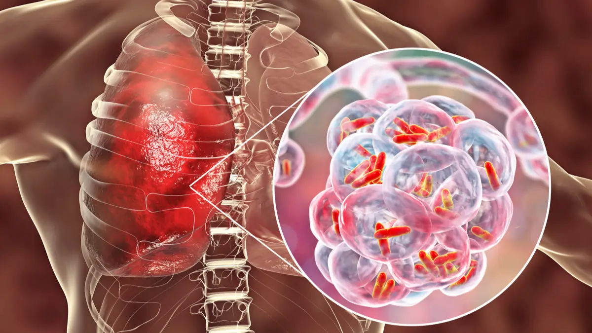Pneumonia